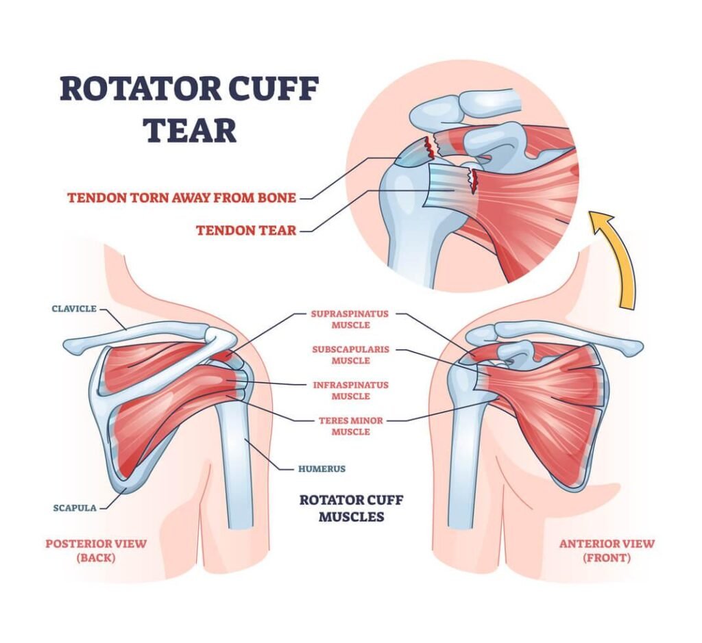 Rotator cuff injury physiotherapy treatment